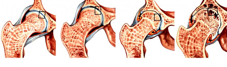 Le degré de développement de la coxarthrose de l'articulation de la hanche. 