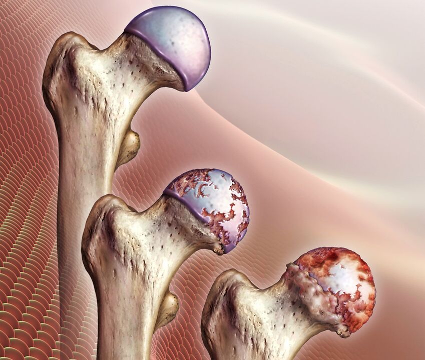 Le développement de l'arthrose de l'articulation de la hanche. 