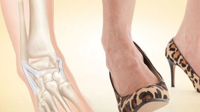 l'utilisation de chaussures à talons comme cause d'arthrose de la cheville