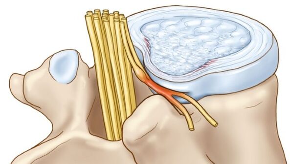 L'ostéochondrose lombaire peut entraîner des complications sous la forme d'une hernie intervertébrale. 