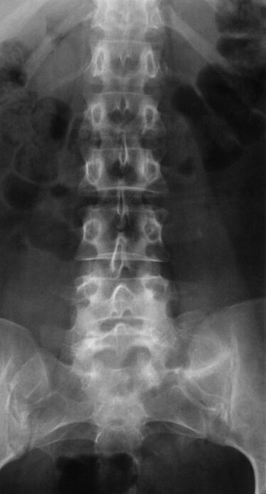 Pour diagnostiquer l'ostéochondrose lombaire, une radiographie est réalisée. 