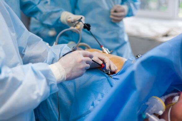 À un stade avancé de l'ostéochondrose du rachis lombaire, une intervention chirurgicale est nécessaire. 