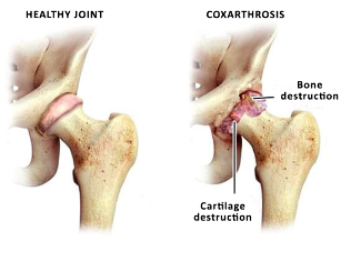 Comparaison d'une Articulation saine et zustavas hip